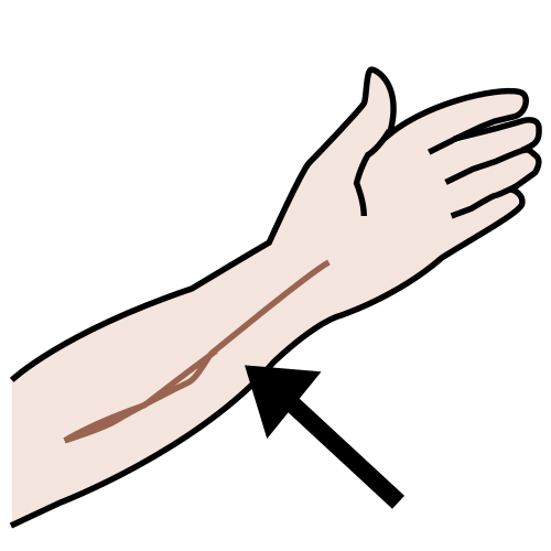 scar