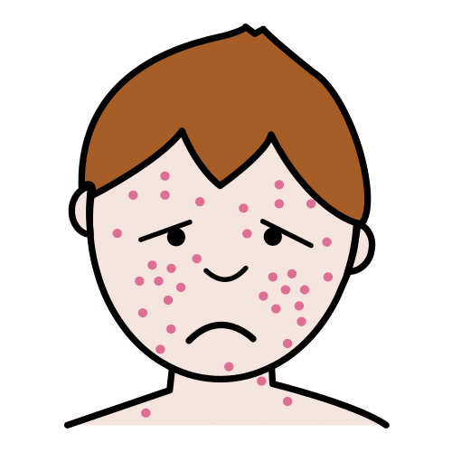 chickenpox