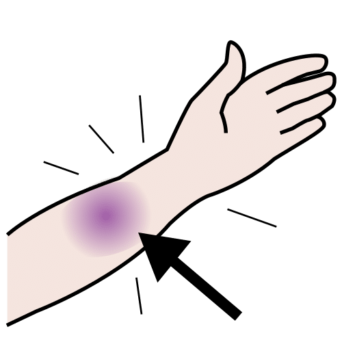 bruise