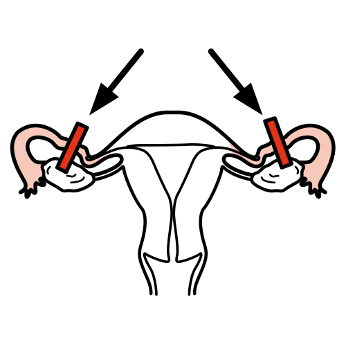 tubal ligation