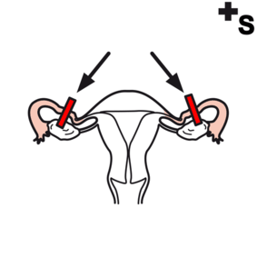 tubal ligation