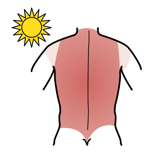 sunburn