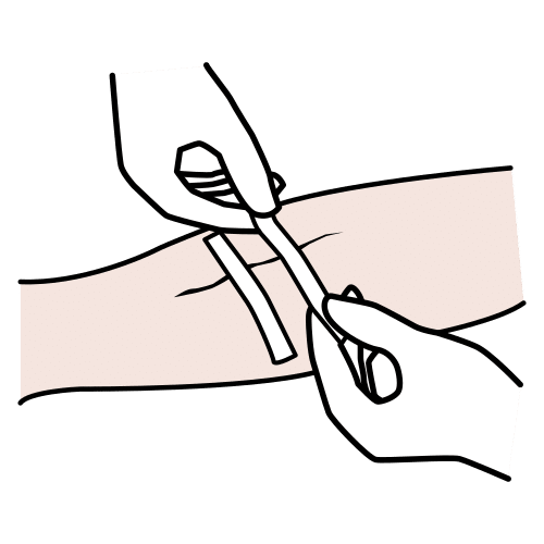 suture