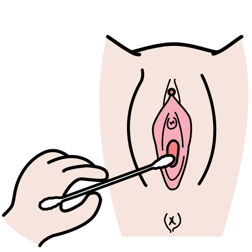 smear test