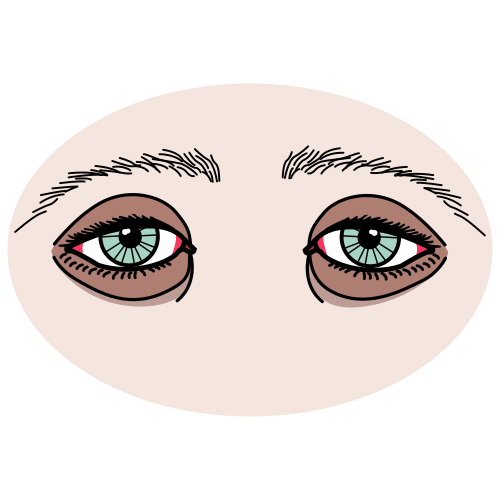 eye bags