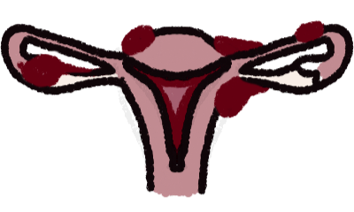 endometriosis
