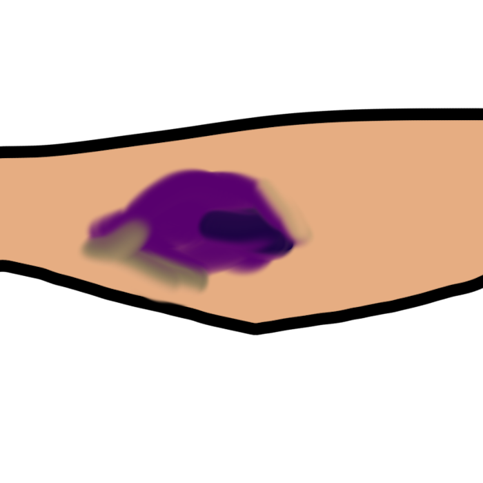 bruise